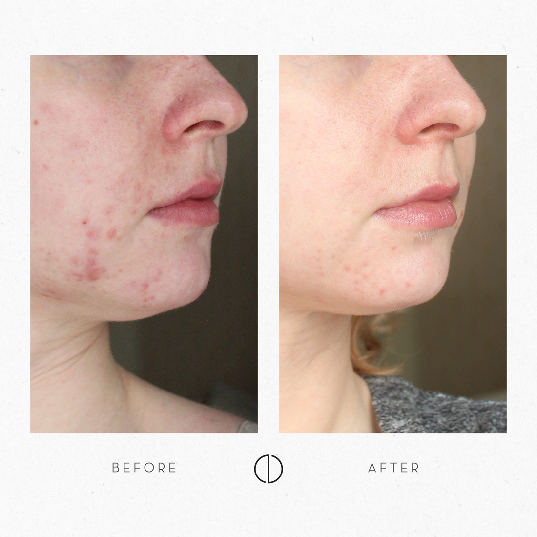 Milja & Sensitive, breakout-prone skin